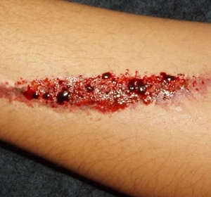 Cuts and Grazes
